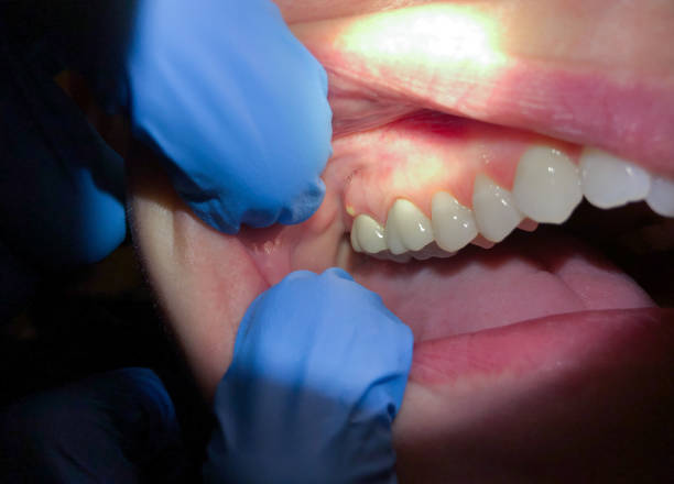 Best Knocked-Out Tooth Emergency  in Mclean, TX